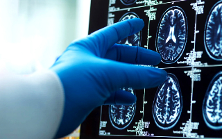 Missed subarachnoid haemorrhage 640x400