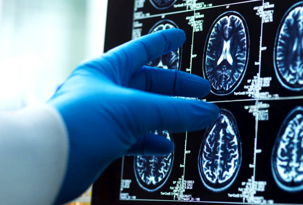 Missed subarachnoid haemorrhage 1248x844