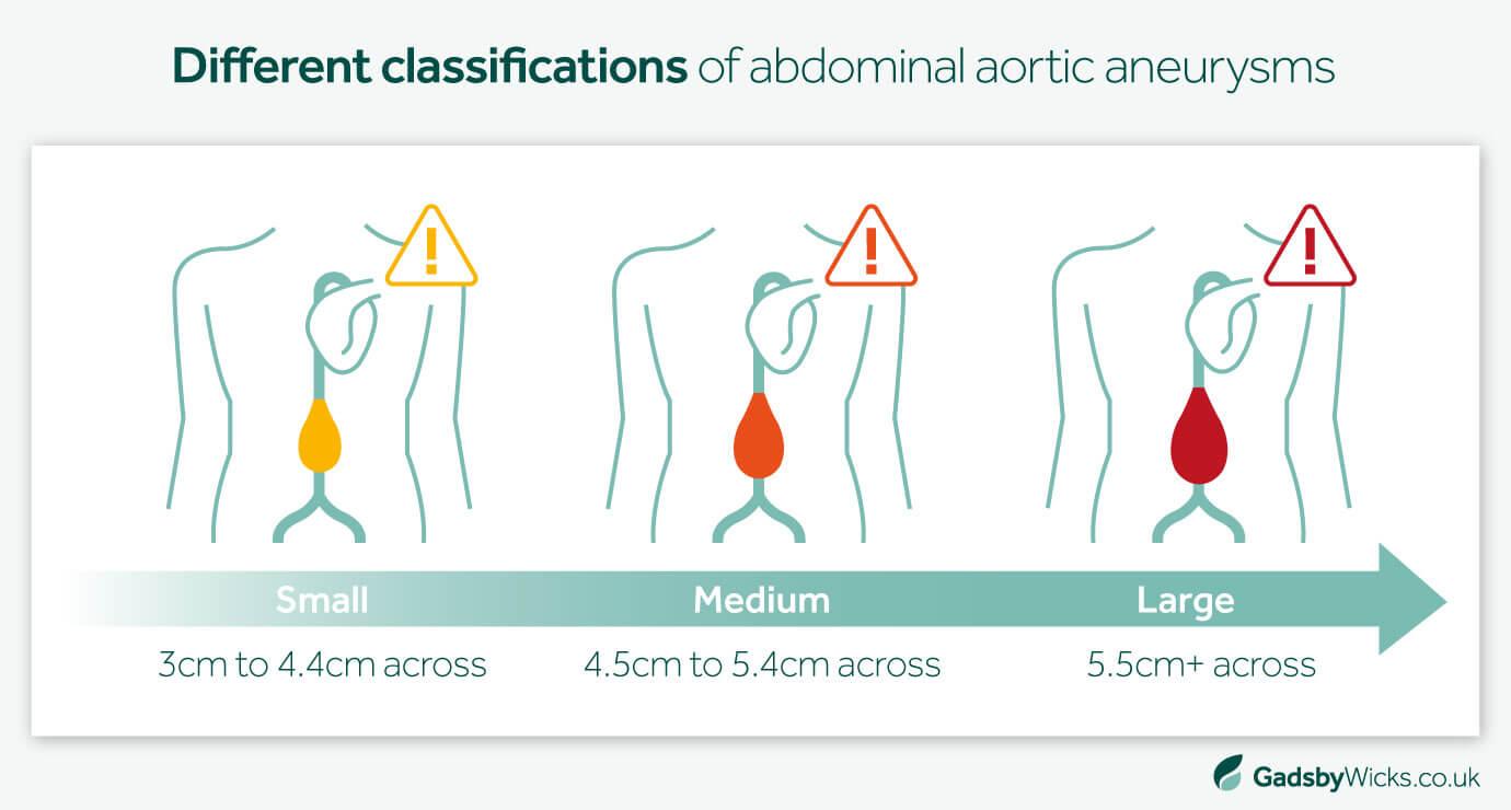 Infographic image of abdominal aortic aneurysm classifications from small to large