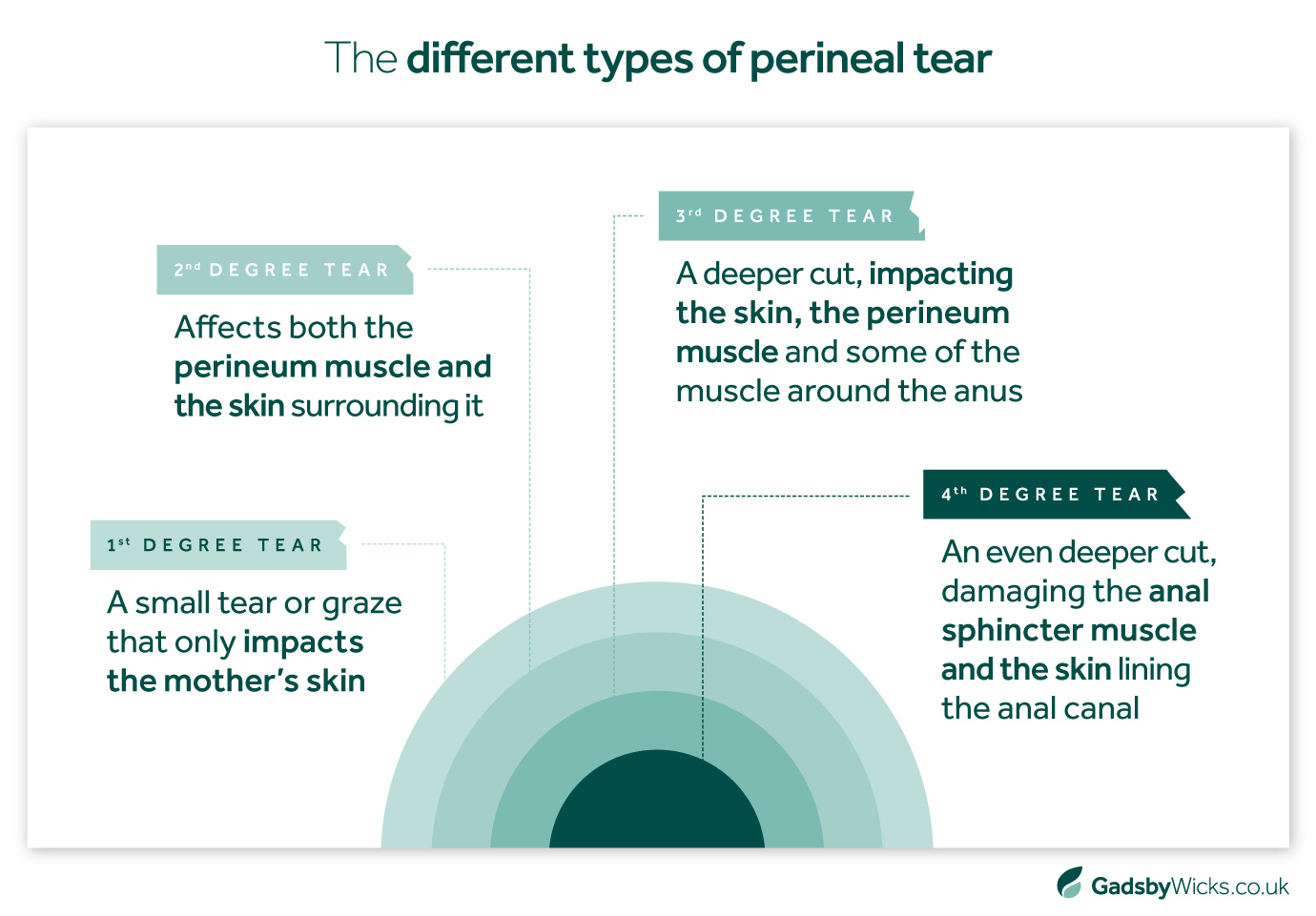 The Different Types of Perineal Tears - Medical Negligence Claims Infographic