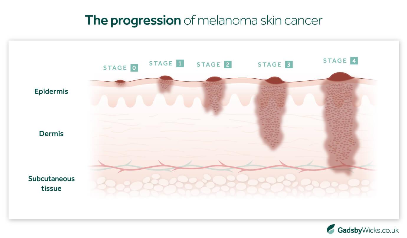 The 4 progressive stages of melanoma skin cancer - image infographic